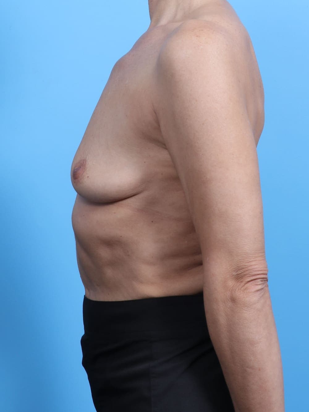 Breast Augmentation case #3452 before, image 3