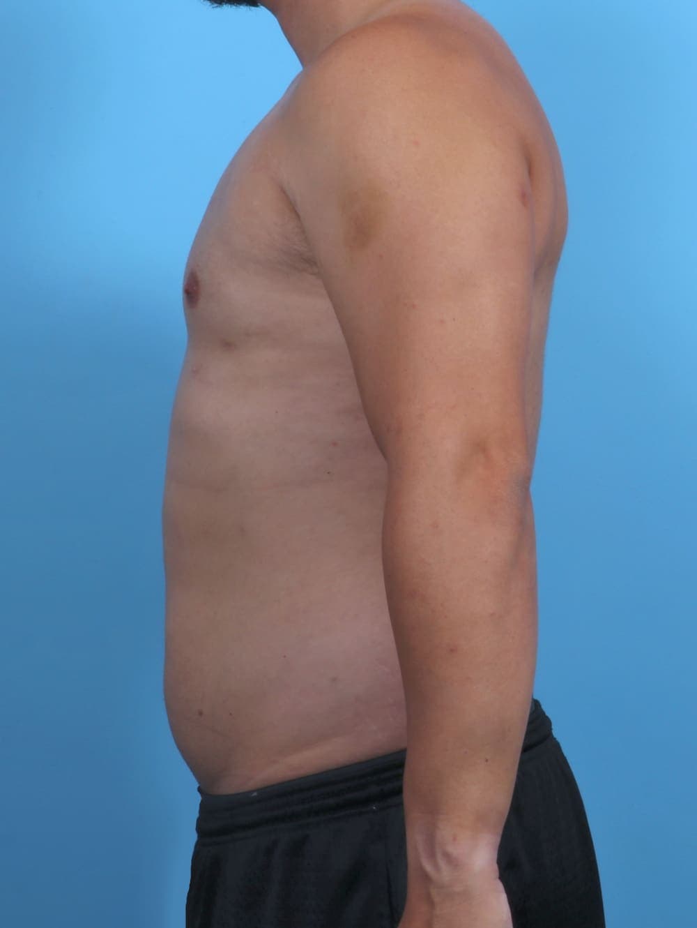 Male Breast Reduction case #3763 after, image 3