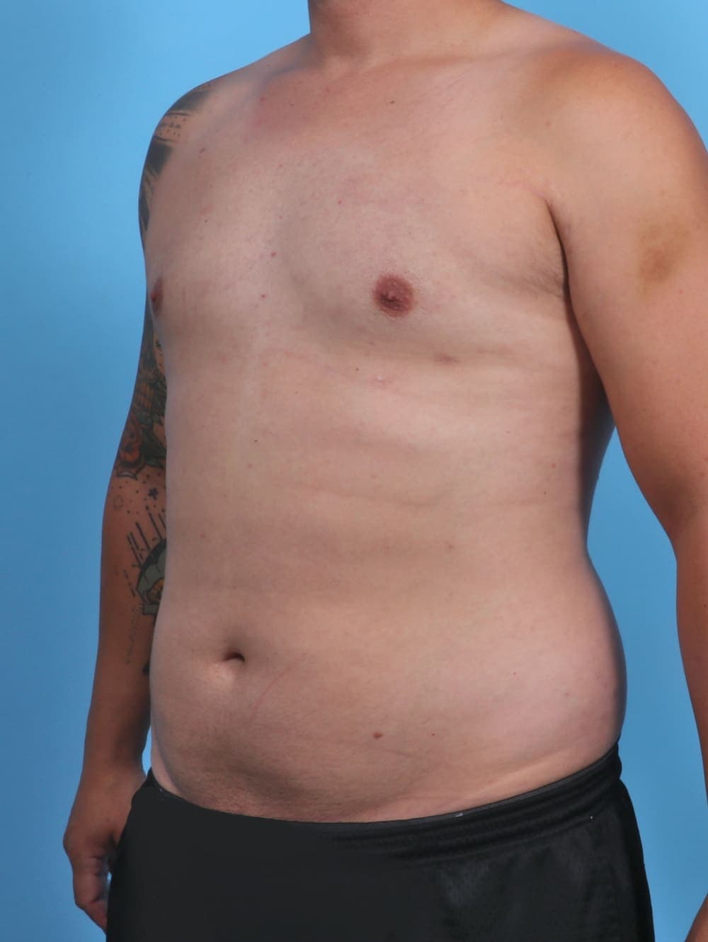 Male Breast Reduction case #3763 after, image 2