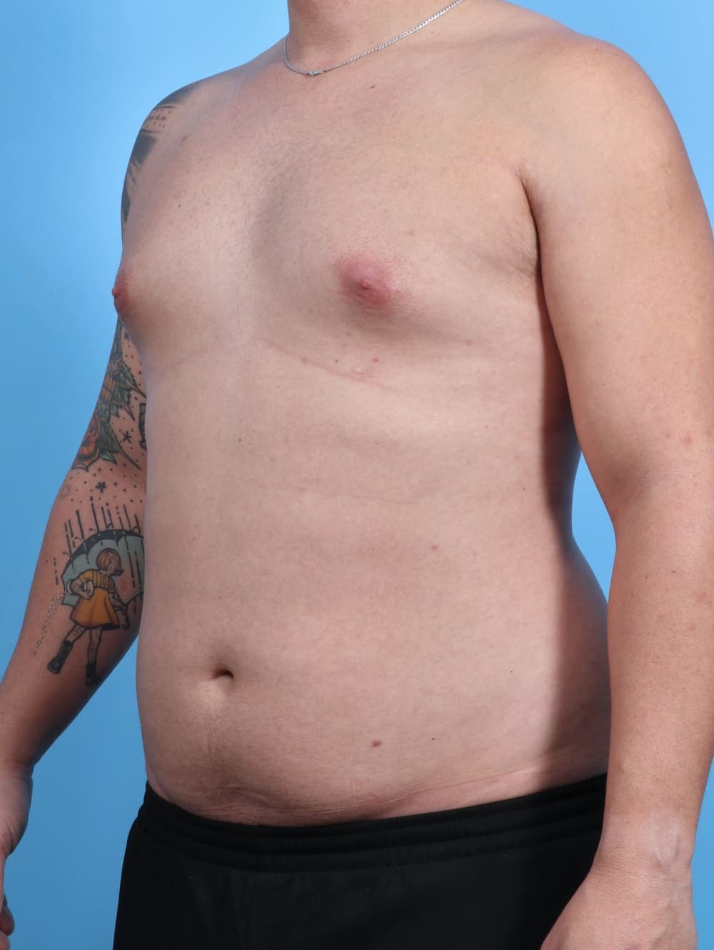 Male Breast Reduction case #3763 before, image 2