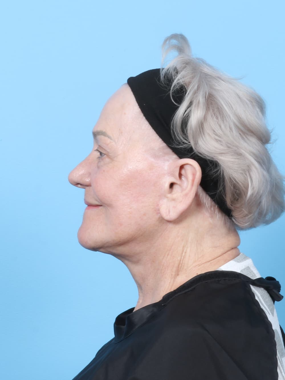 Facelift case #8177 after, image 4