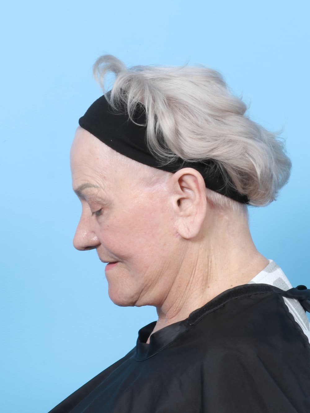 Facelift case #8177 after, image 2