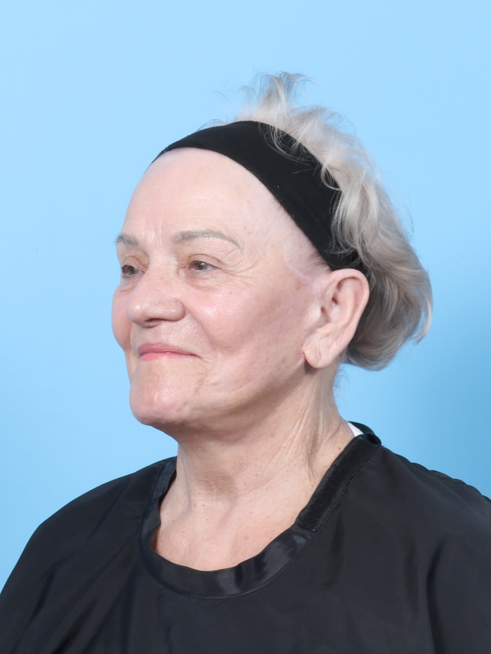 Facelift case #8177 after, image 3