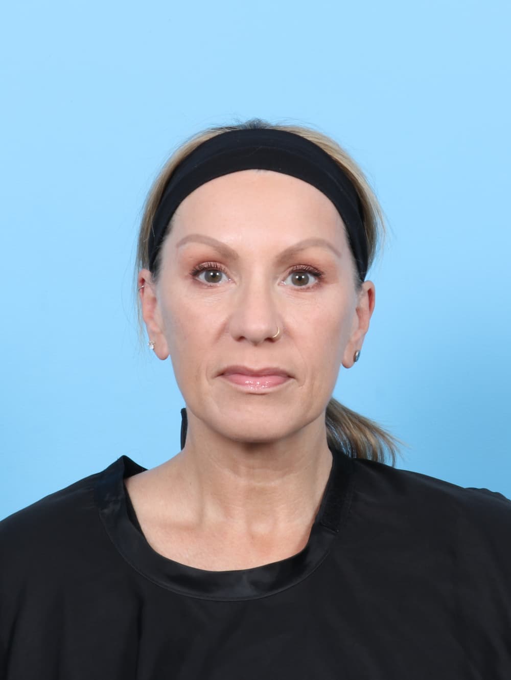 Eyelid Surgery case #7331 after