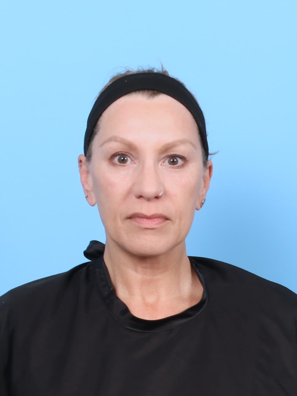 Eyelid Surgery case #7331 before