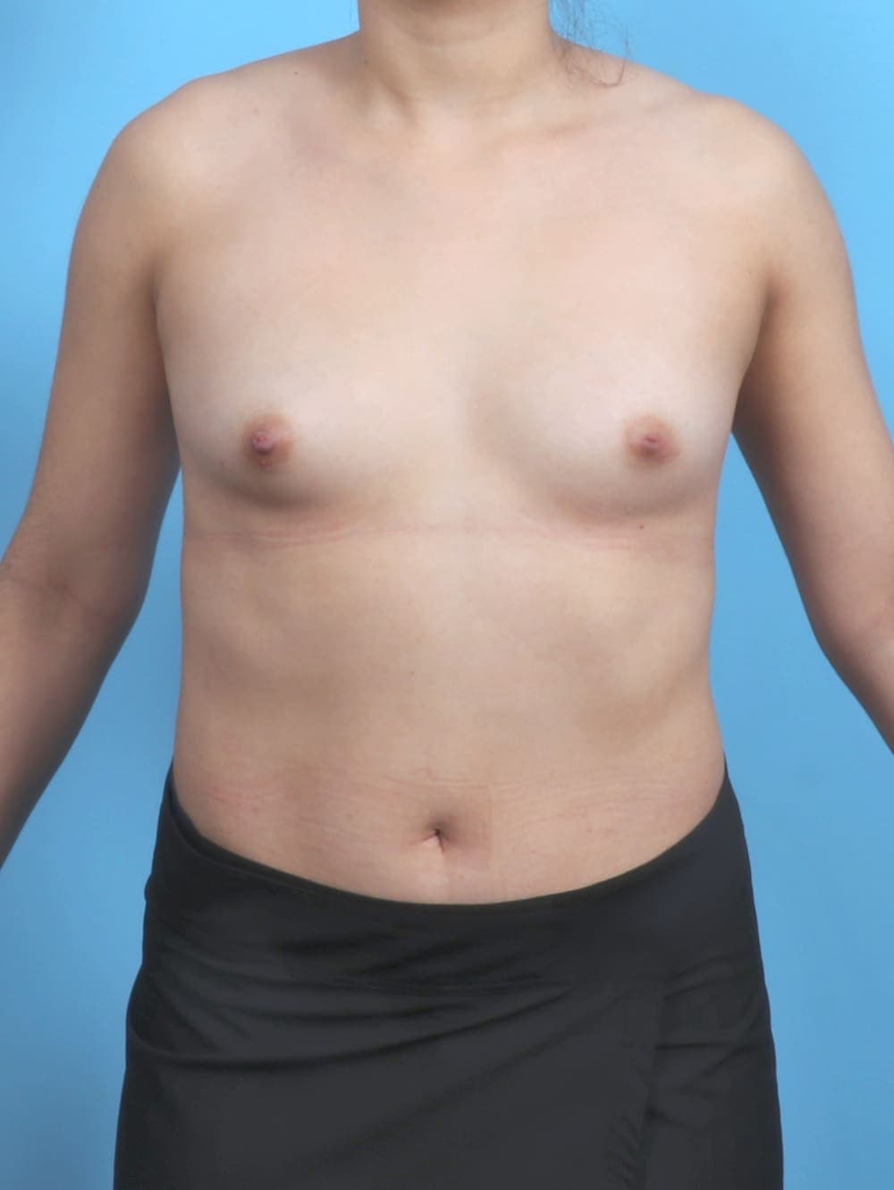Breast Augmentation case #5498 before, image 1