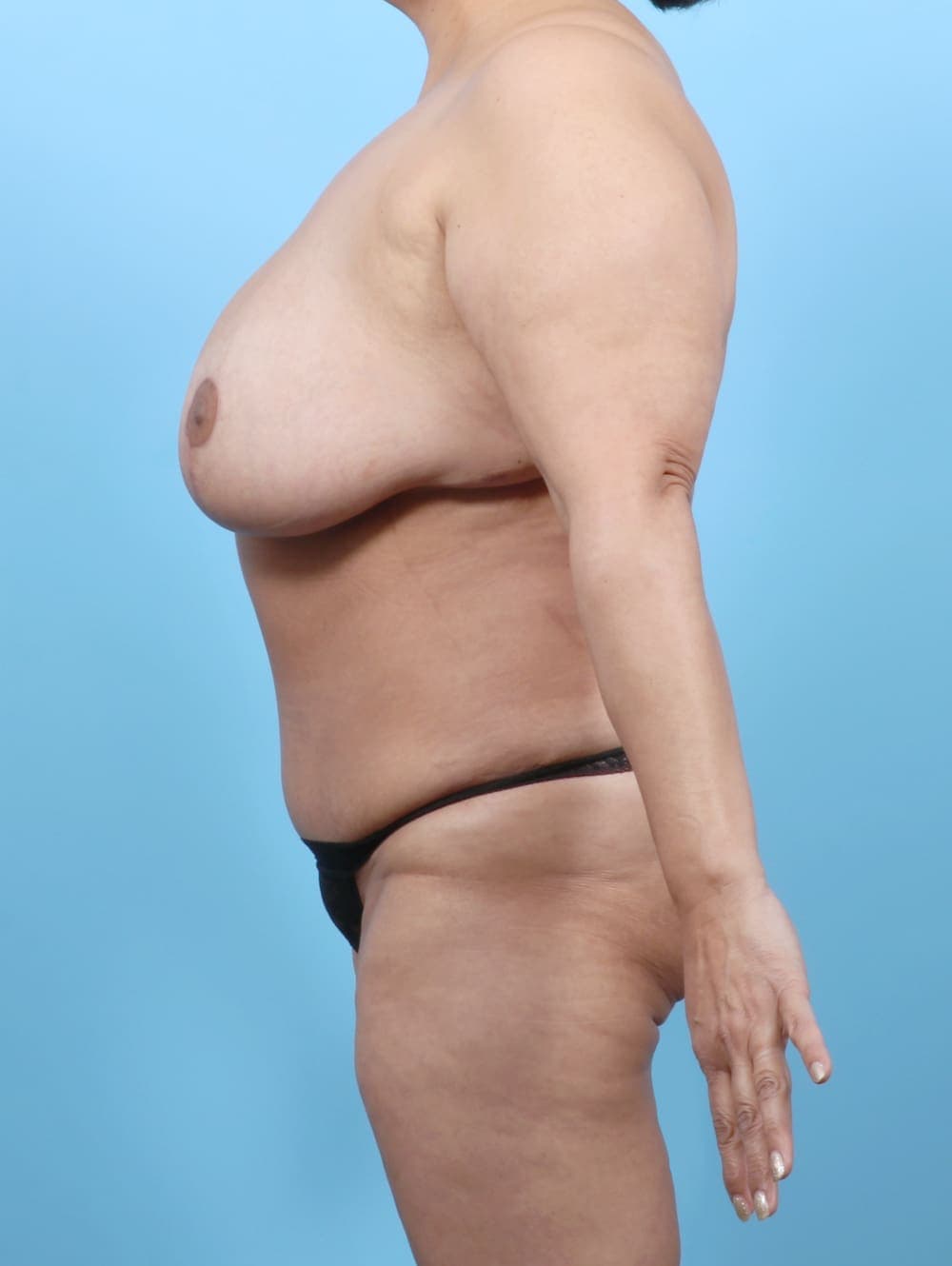 Mommy Makeover case #6459 after, image 4