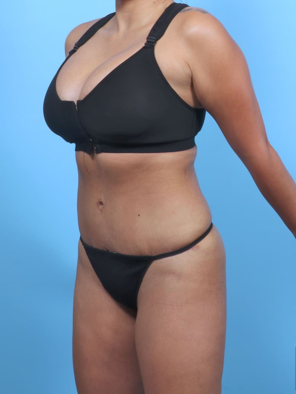 Tummy Tuck case #5349 after, image 2