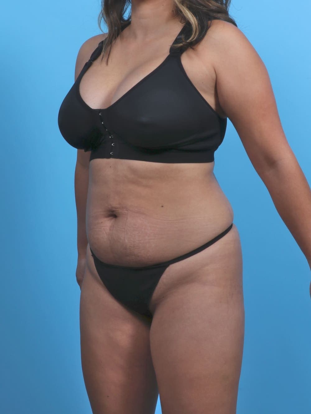 Tummy Tuck case #5349 before, image 2