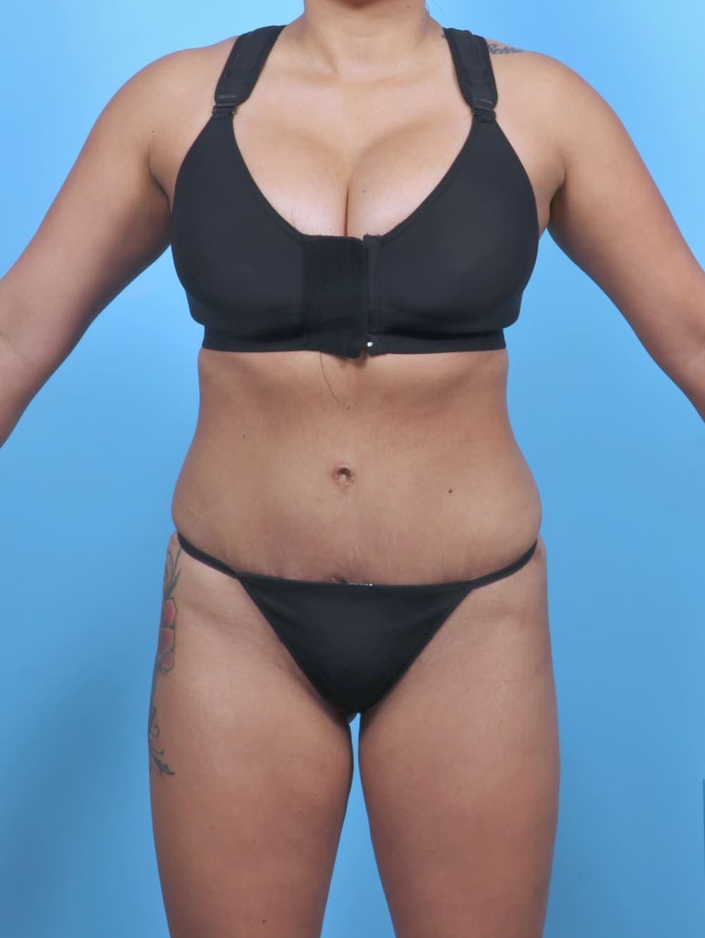 Tummy Tuck case #5349 after, image 1