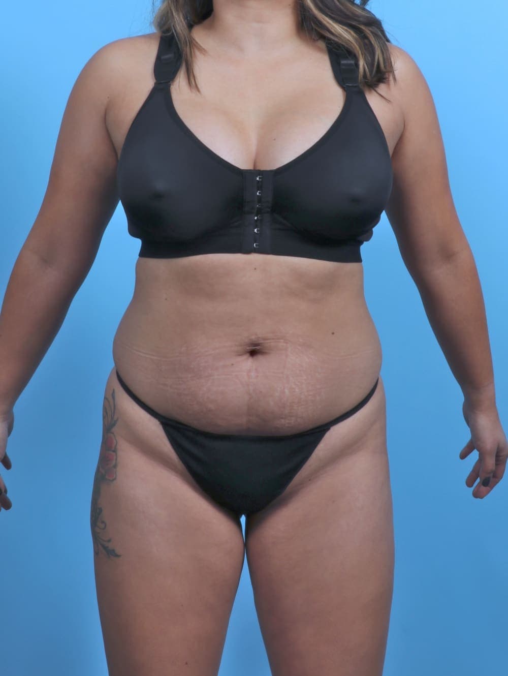 Tummy Tuck case #5349 before, image 1