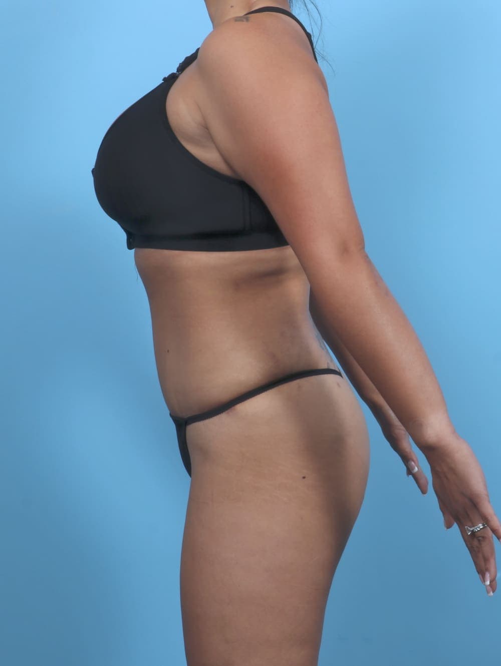 Tummy Tuck case #5349 after, image 4