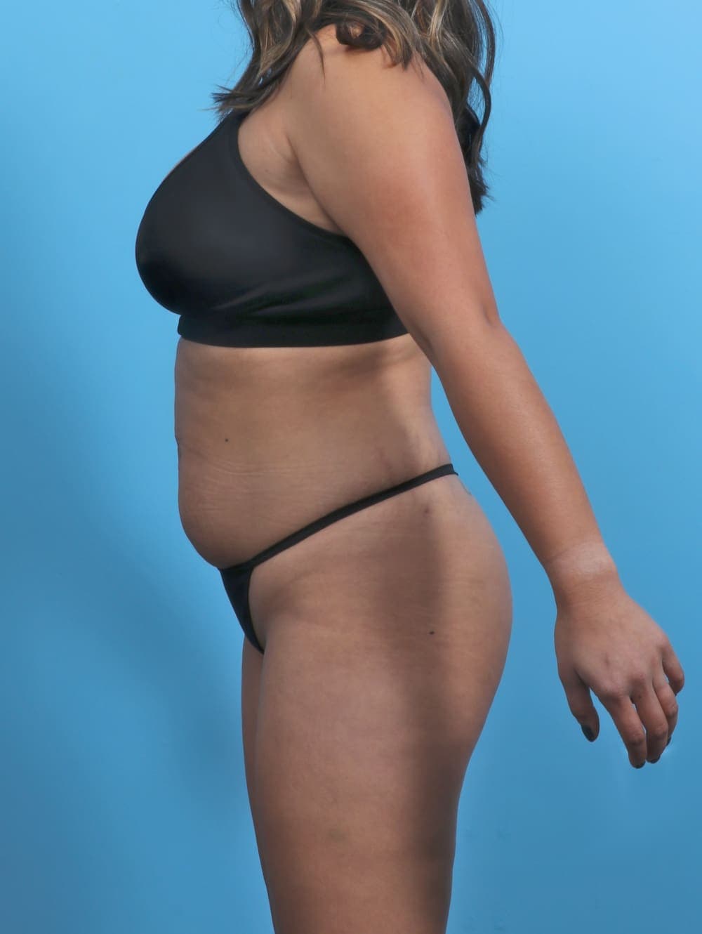 Tummy Tuck case #5349 before, image 4