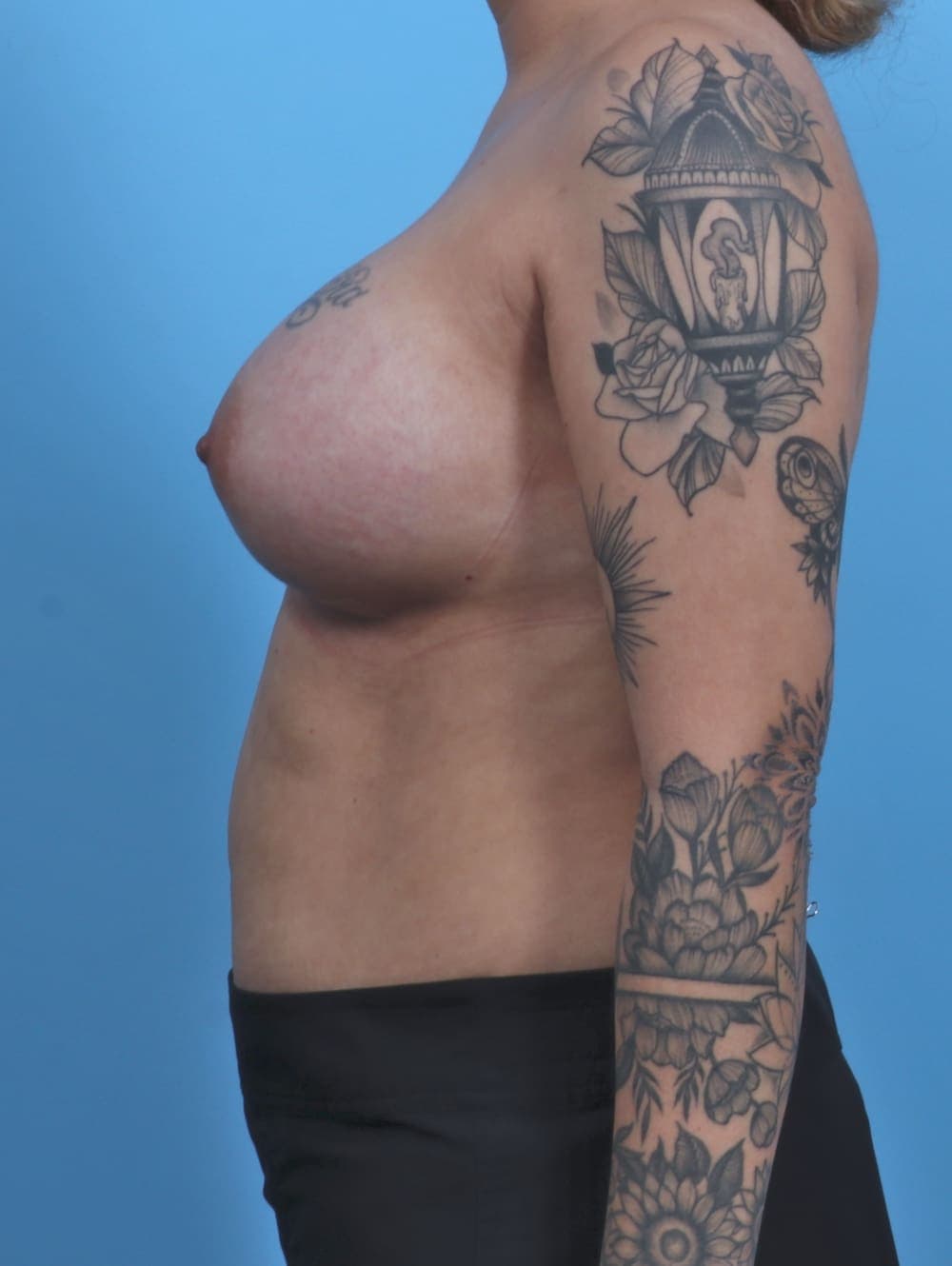 Breast Augmentation case #4463 after, image 3