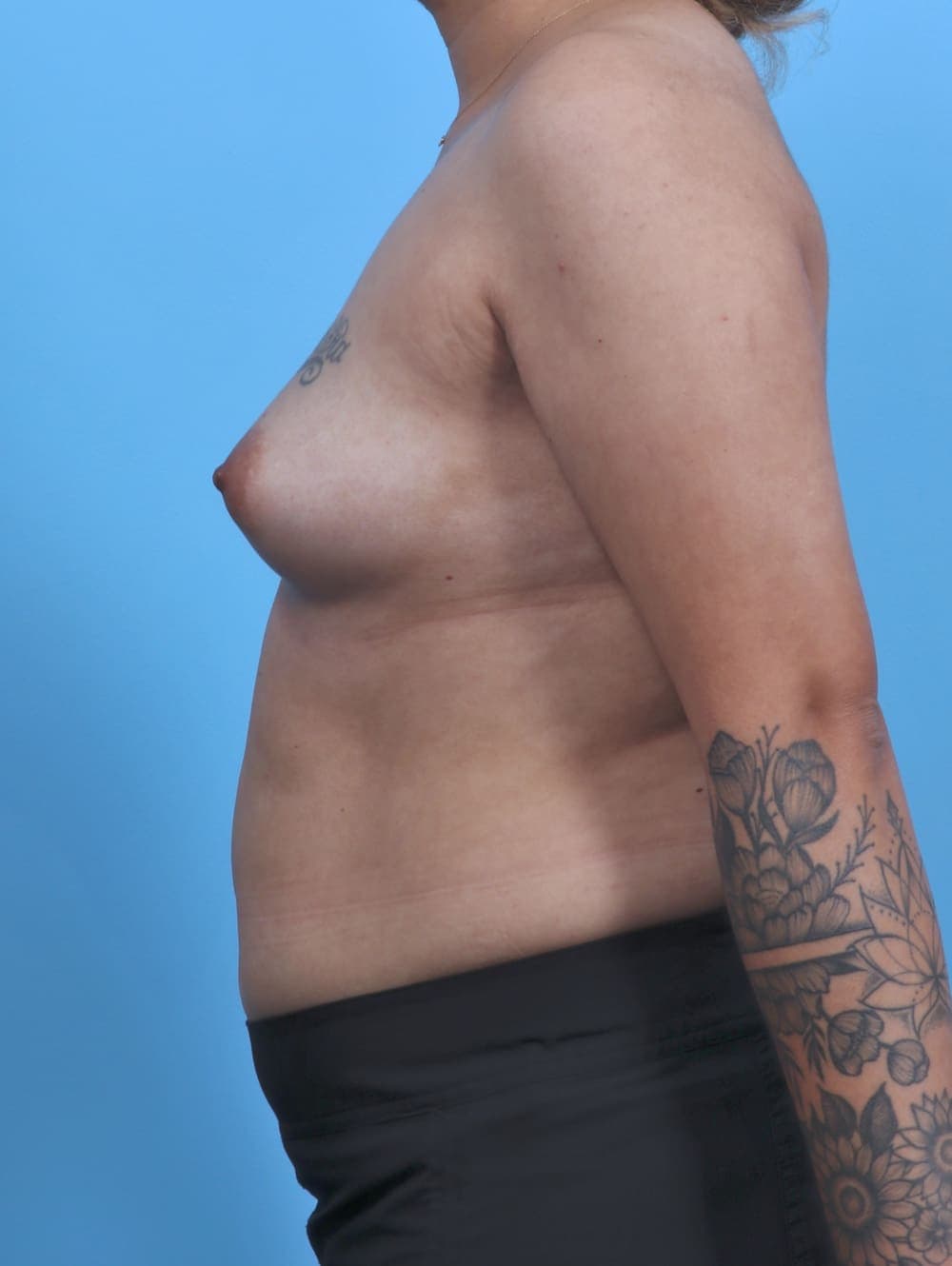 Breast Augmentation case #4463 before, image 3