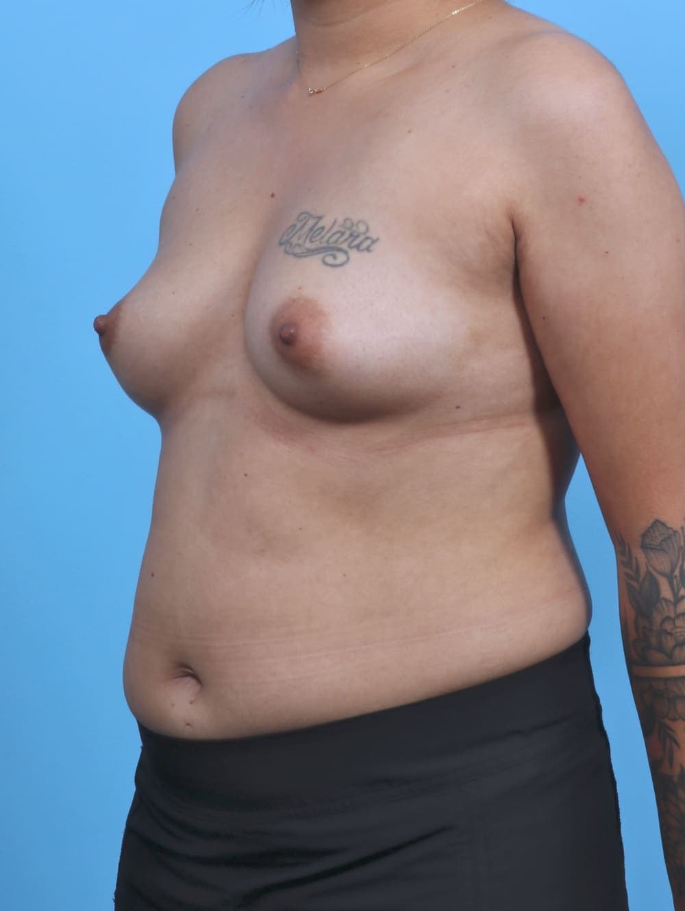 Breast Augmentation case #4463 before, image 2