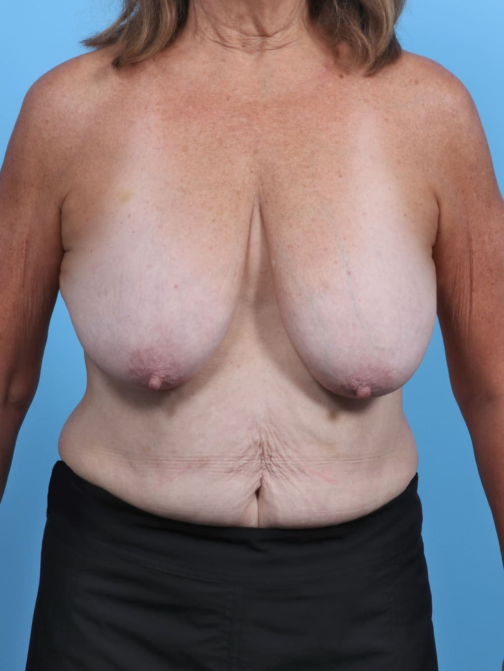 Breast Lift/Reduction case #4963 before, image 1