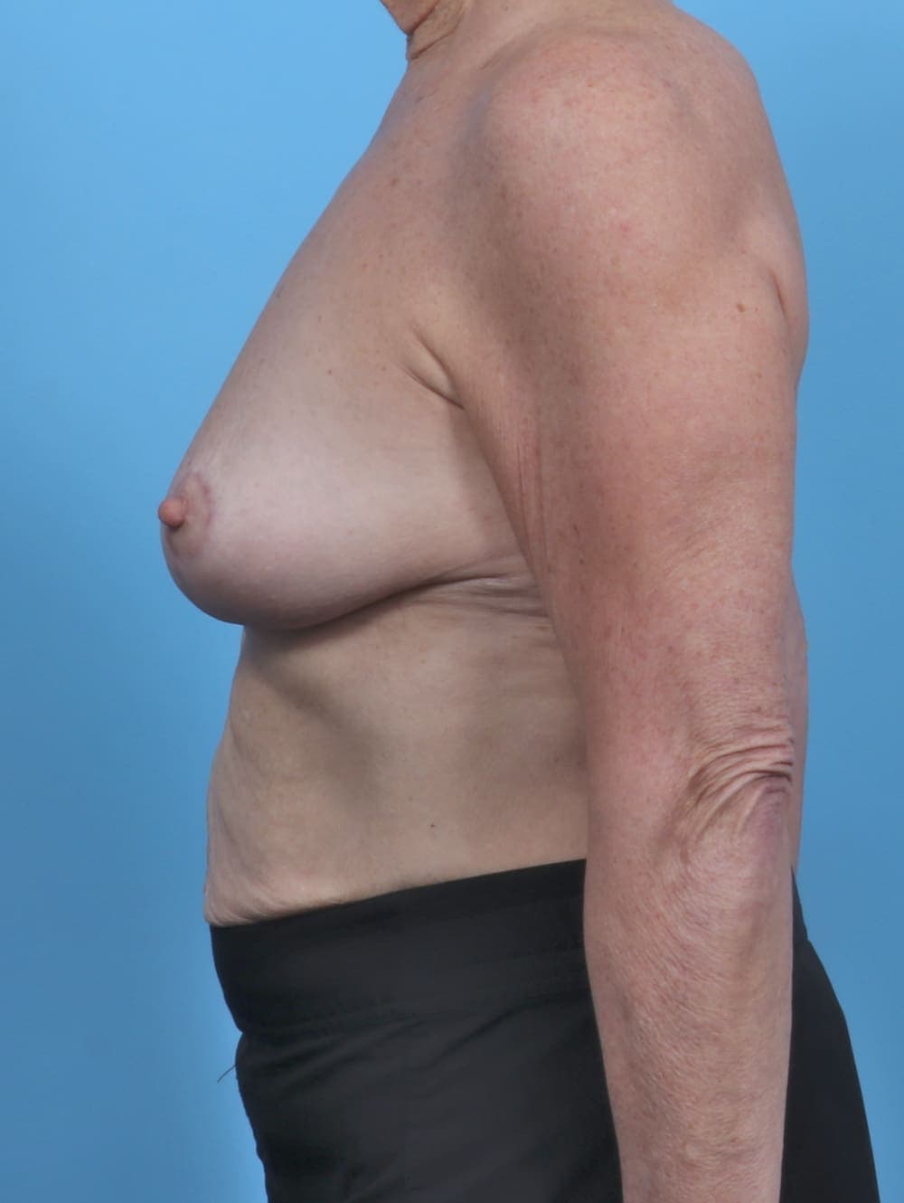 Breast Lift/Reduction case #4963 after, image 3