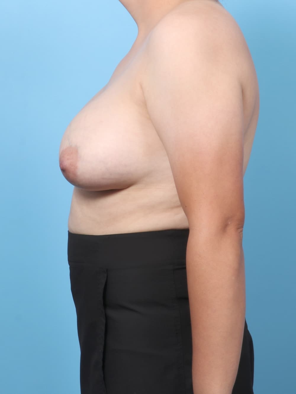 Breast Implant Removal with Lift case #8814 before, image 3
