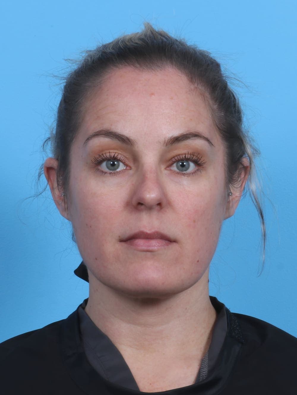Facial Liposuction case #3975 after, image 1