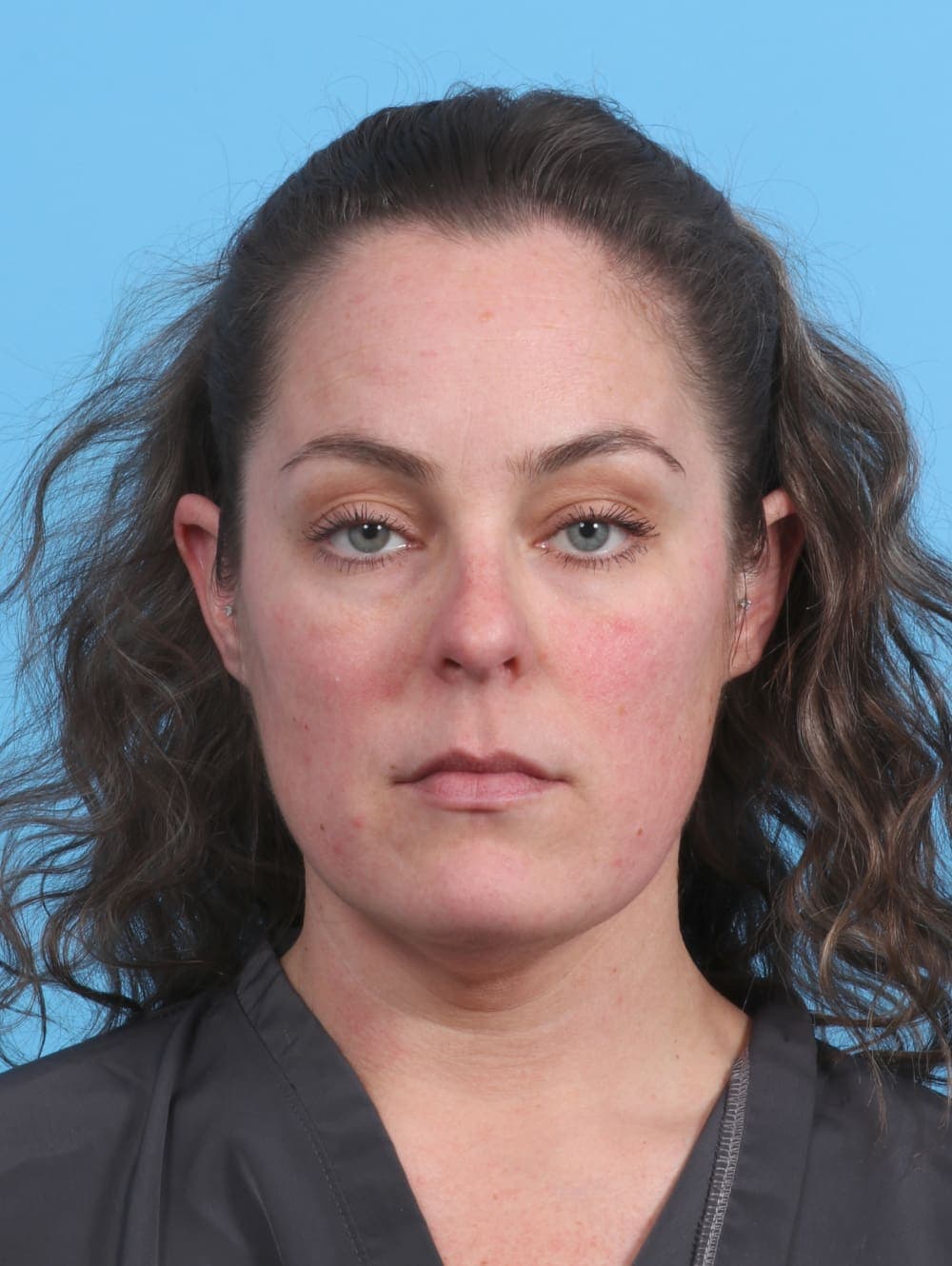Facial Liposuction case #3975 before, image 1