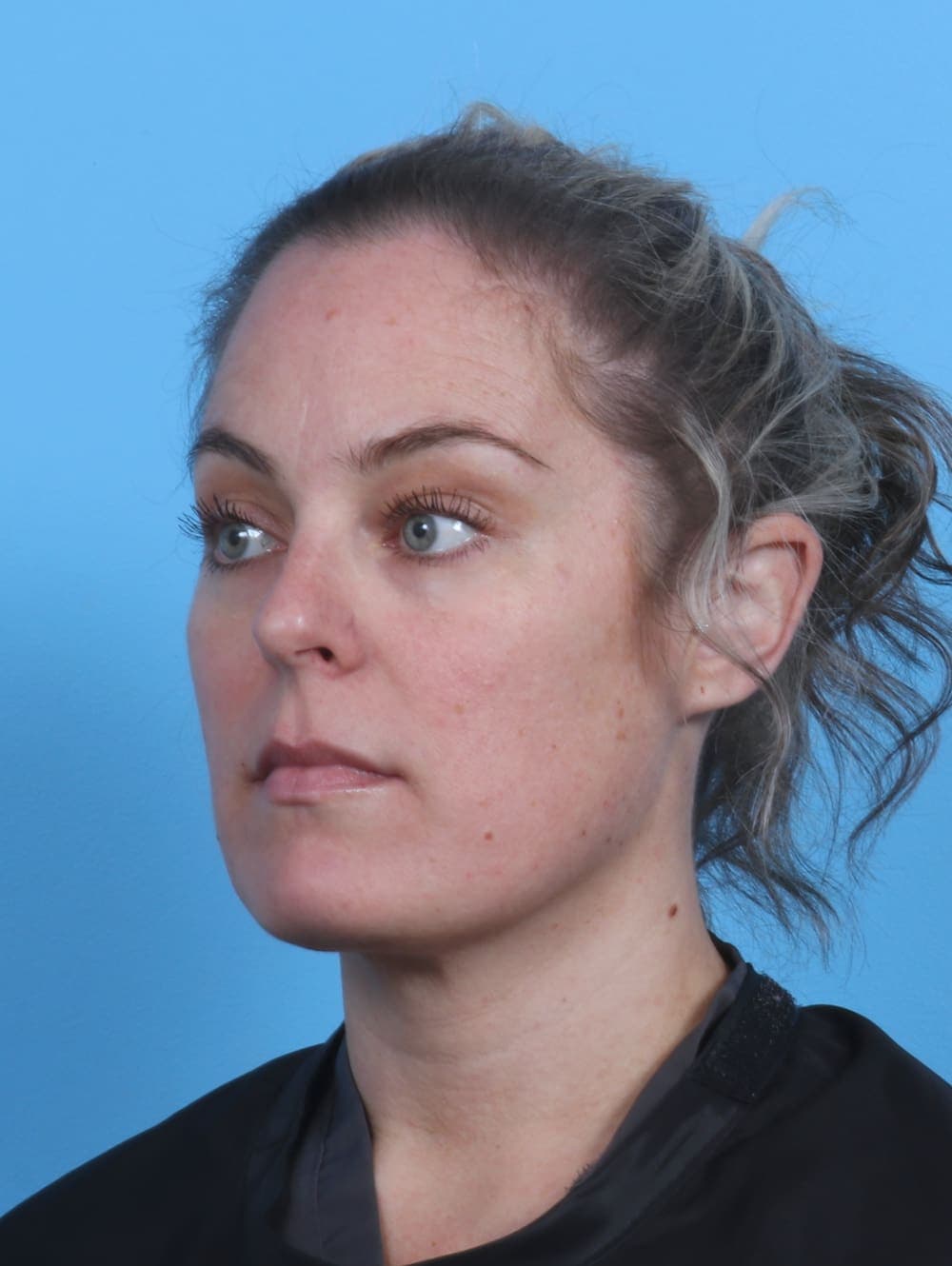 Facial Liposuction case #3975 after, image 2
