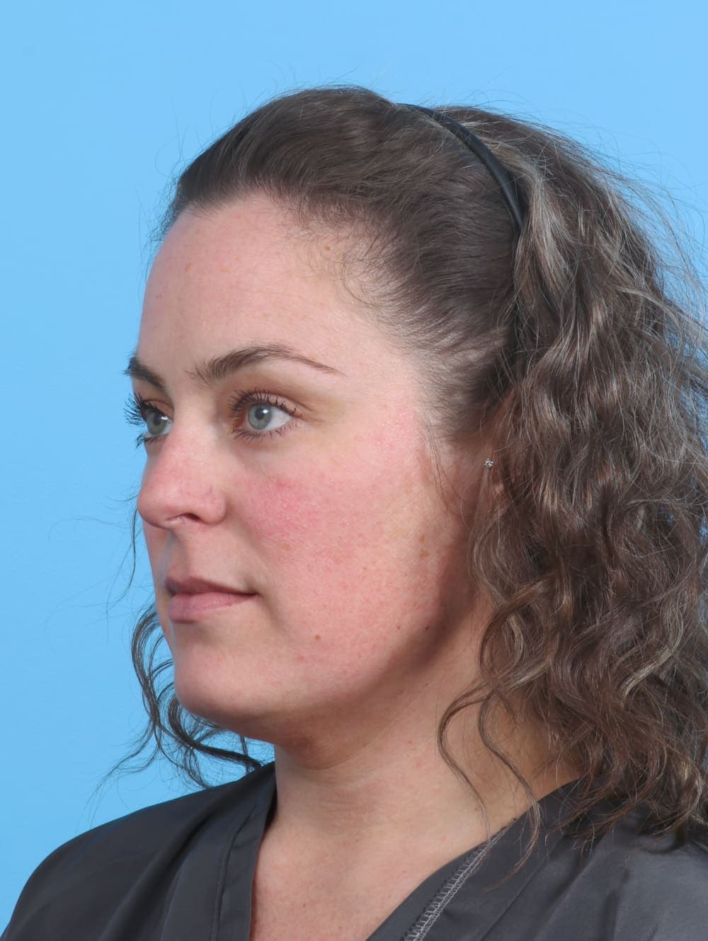 Facial Liposuction case #3975 before, image 2