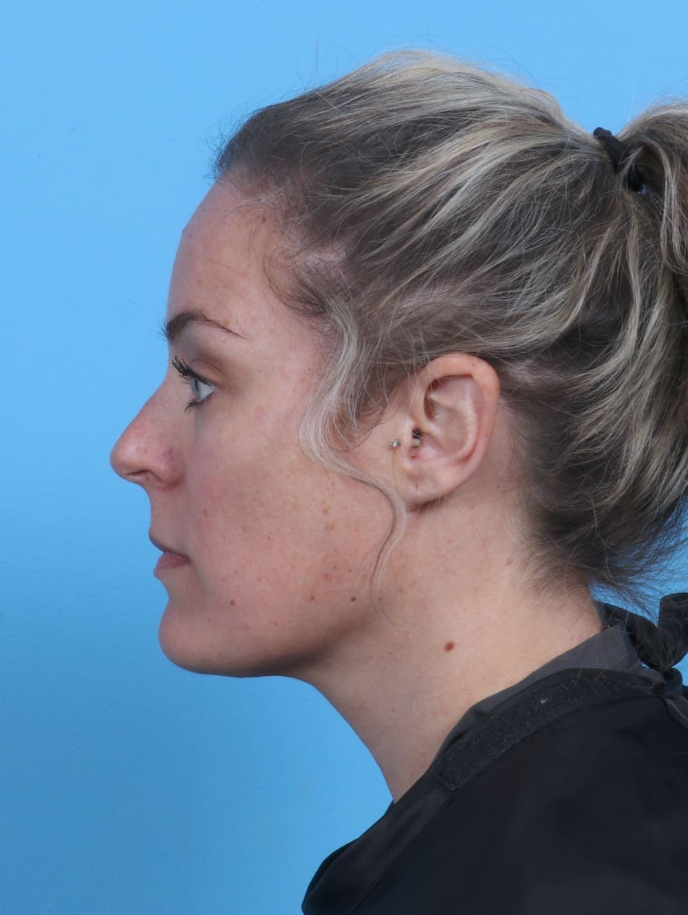 Facial Liposuction case #3975 after, image 3