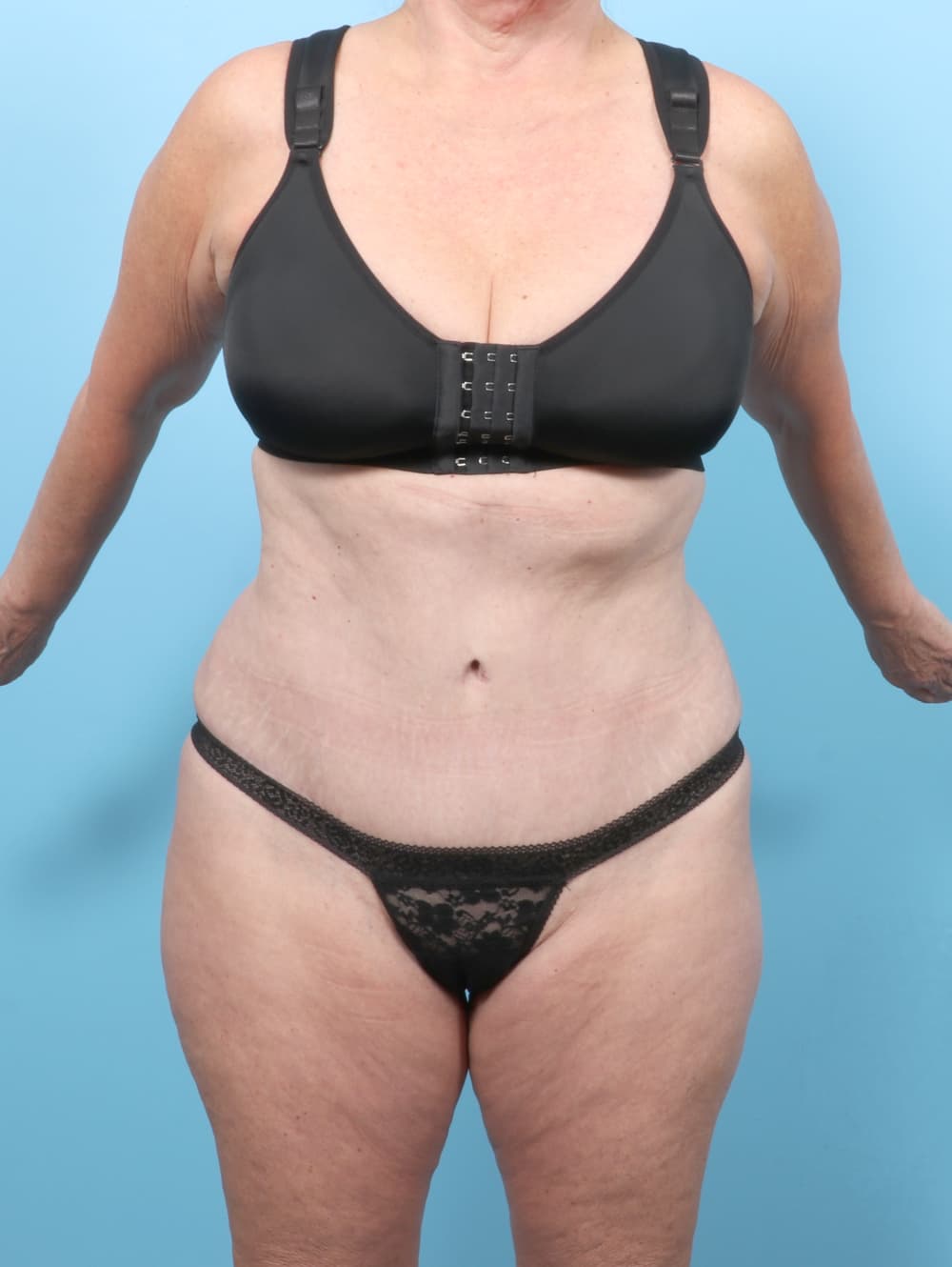 Tummy Tuck case #7461 after, image 1