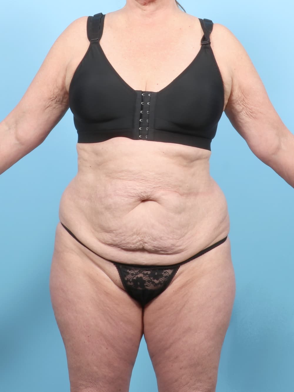 Tummy Tuck case #7461 before, image 1
