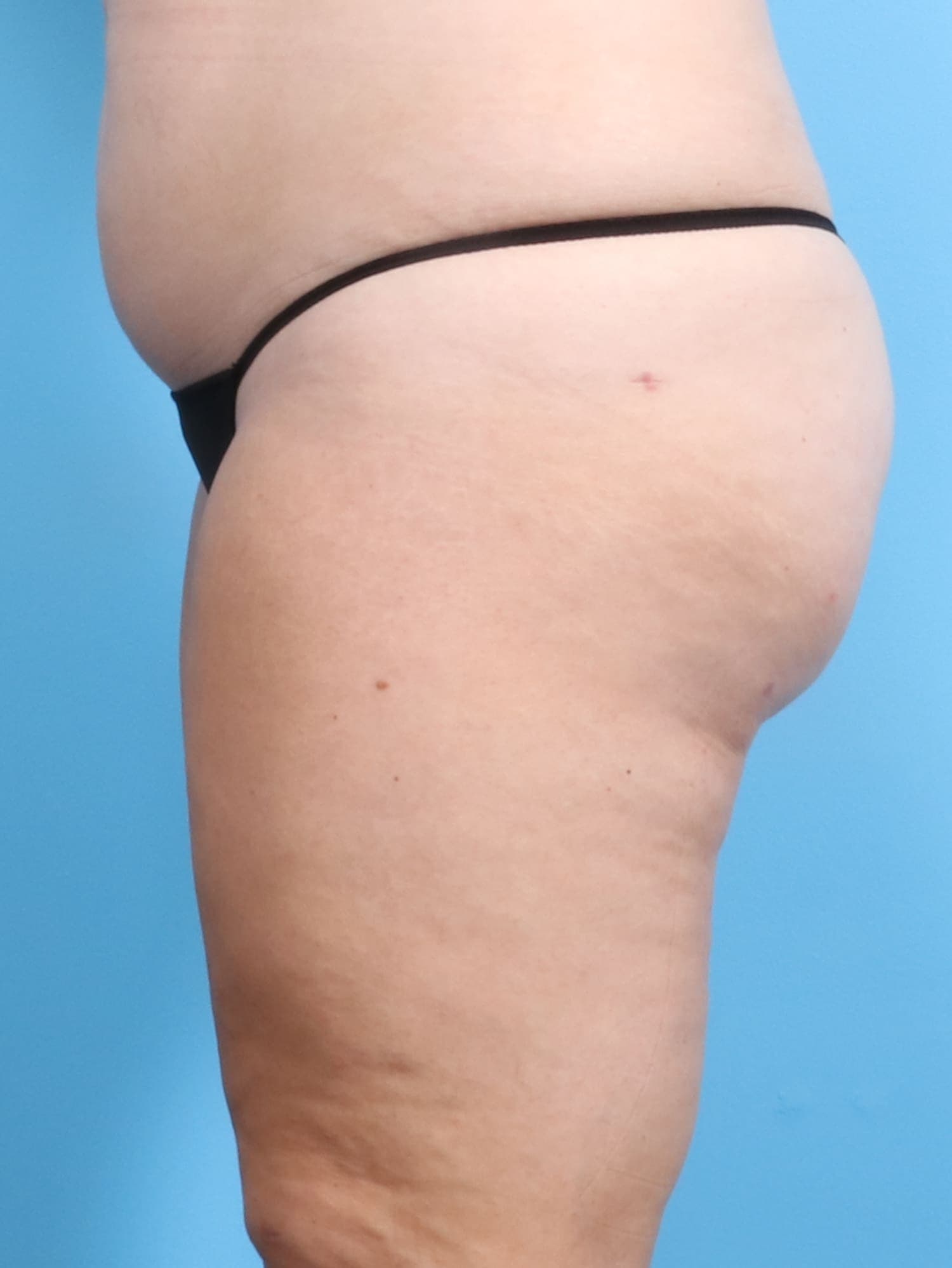 Liposuction case #1257 after, image 3