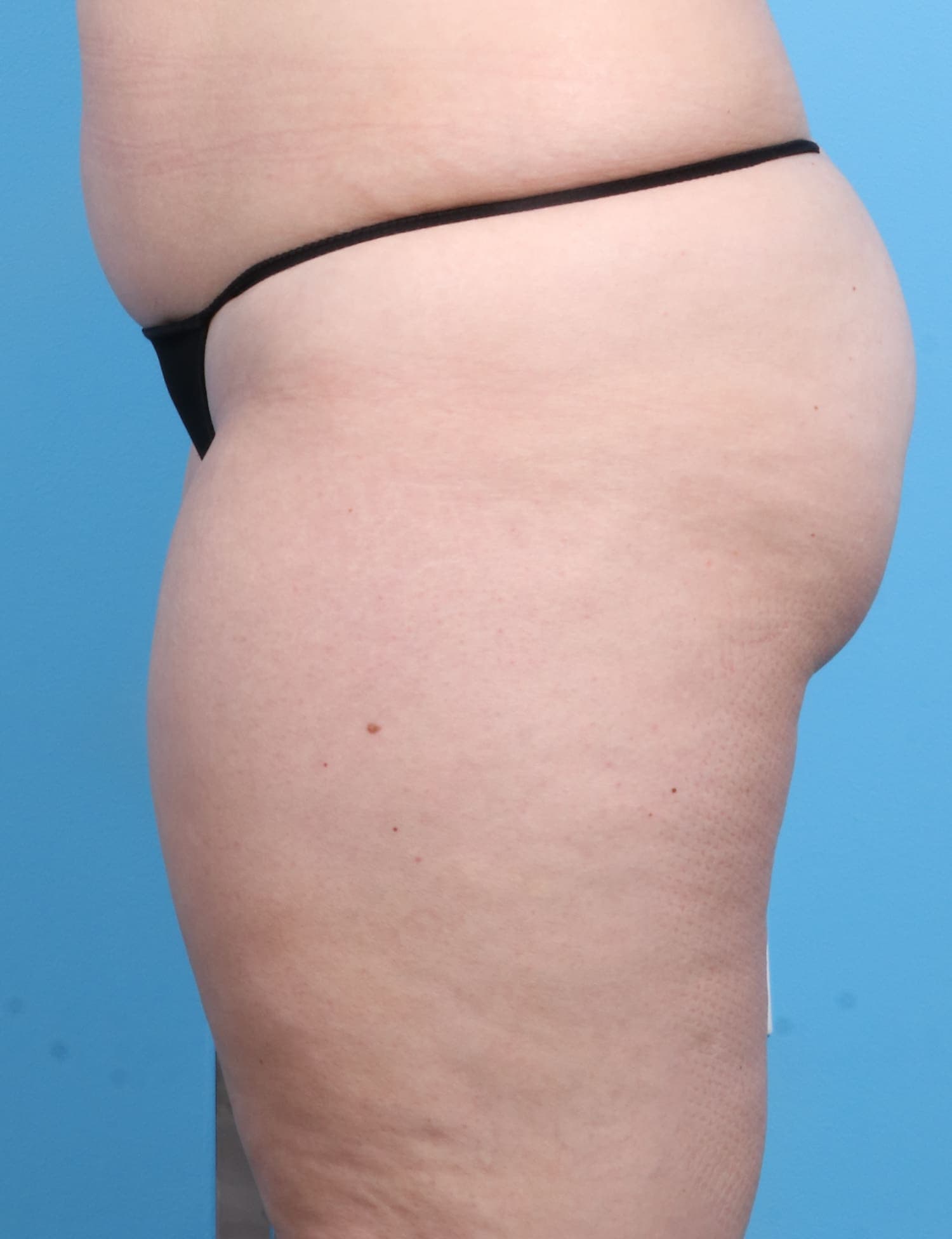 Liposuction case #1257 before, image 3