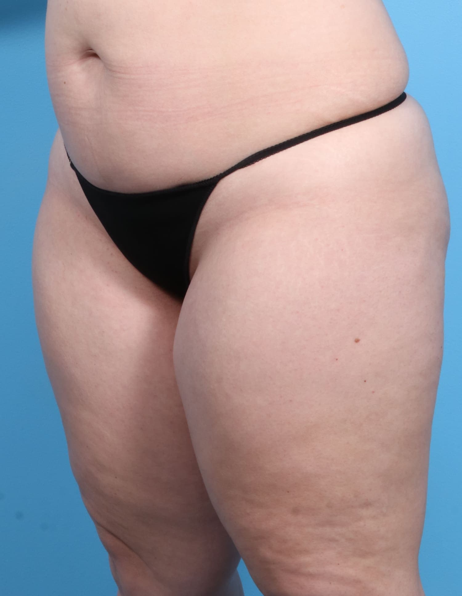 Liposuction case #1257 before, image 2