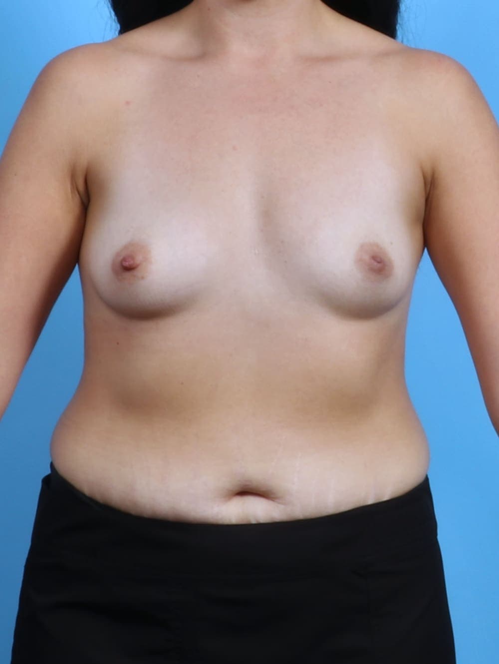 Breast Augmentation case #3739 before, image 1
