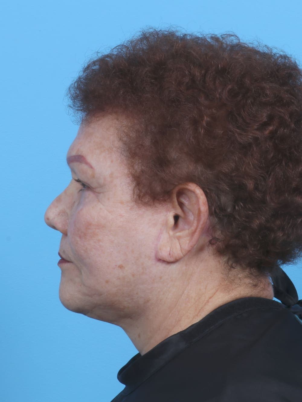 Facelift case #3898 after, image 3