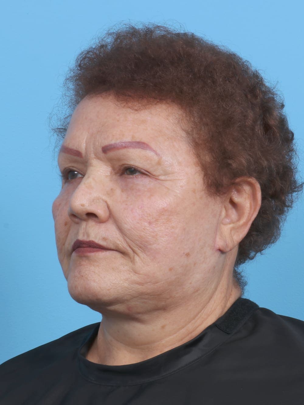 Facelift case #3898 after, image 2
