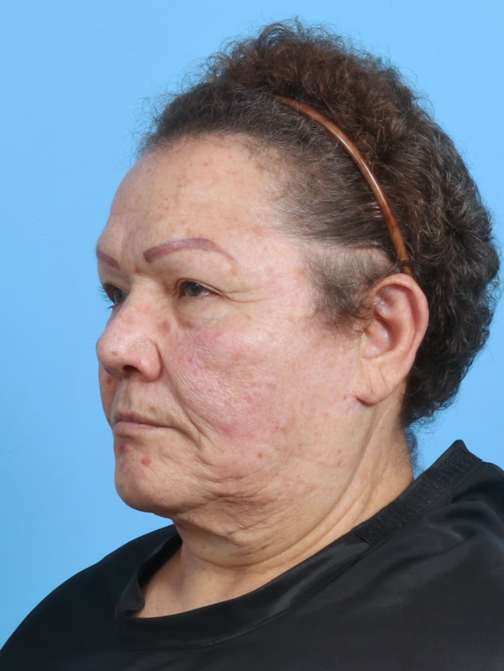 Facelift case #3898 before, image 2