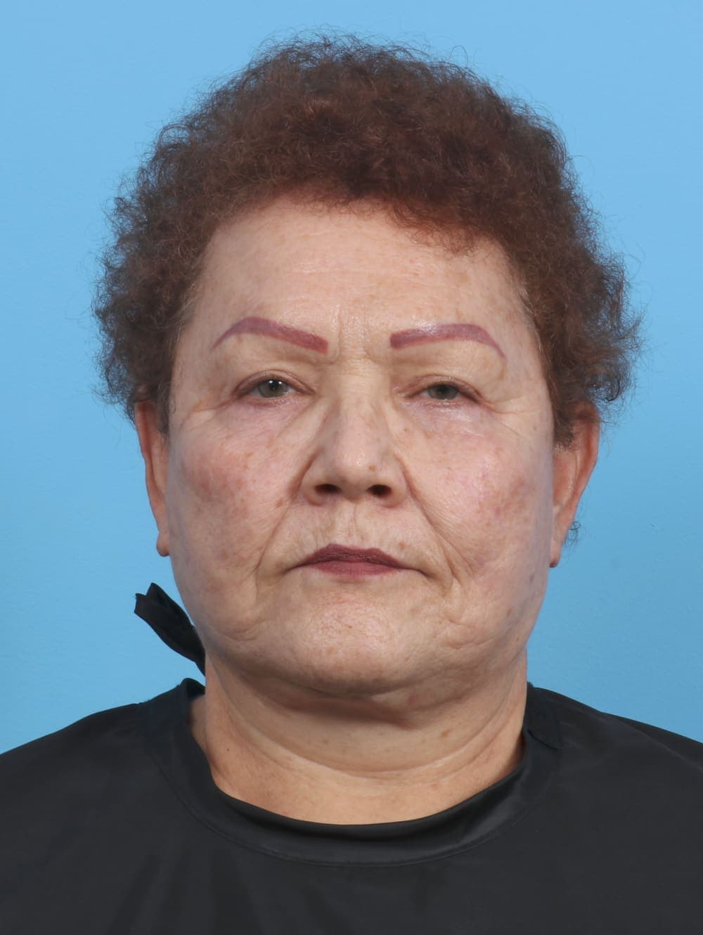Facelift case #3898 after, image 1