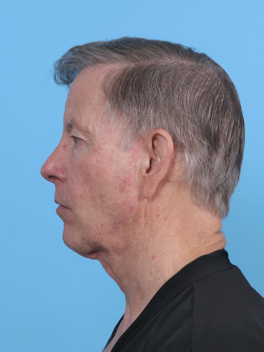 Ear Surgery case #4432 before, image 3