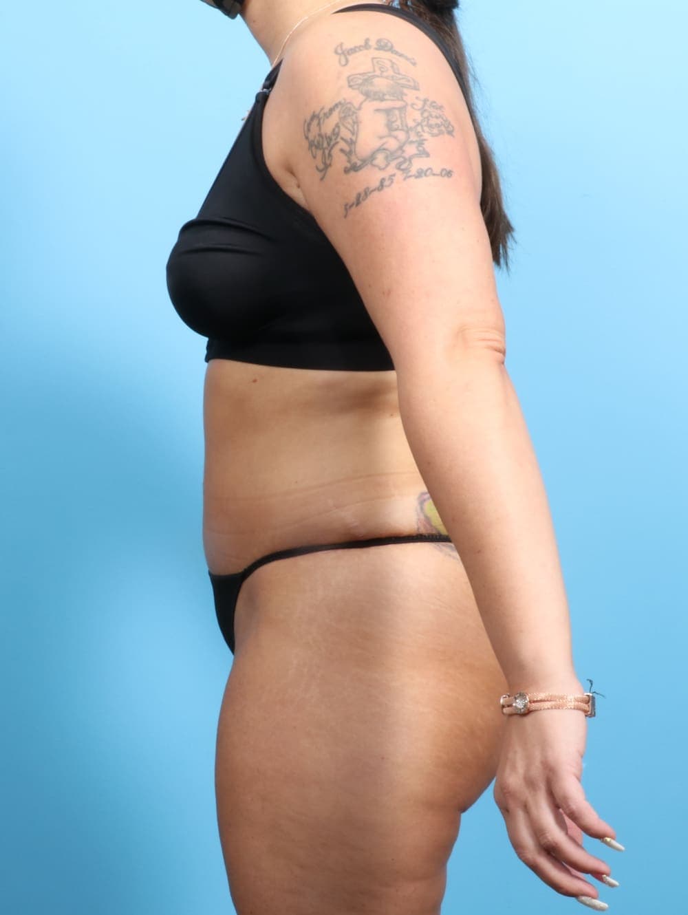 Liposuction case #2187 after, image 3