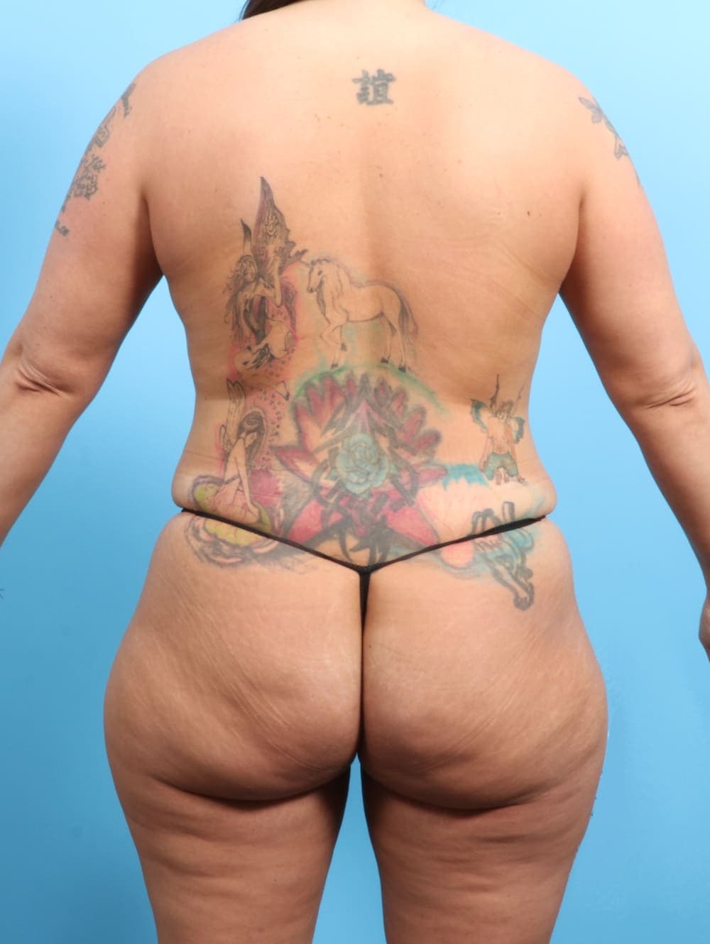 Liposuction case #2187 after, image 4