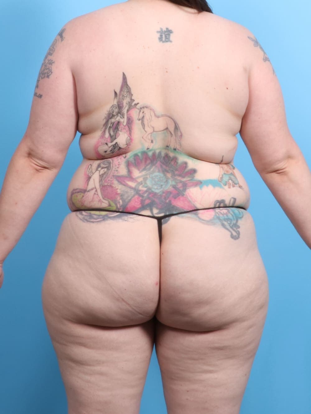 Liposuction case #2187 before, image 4