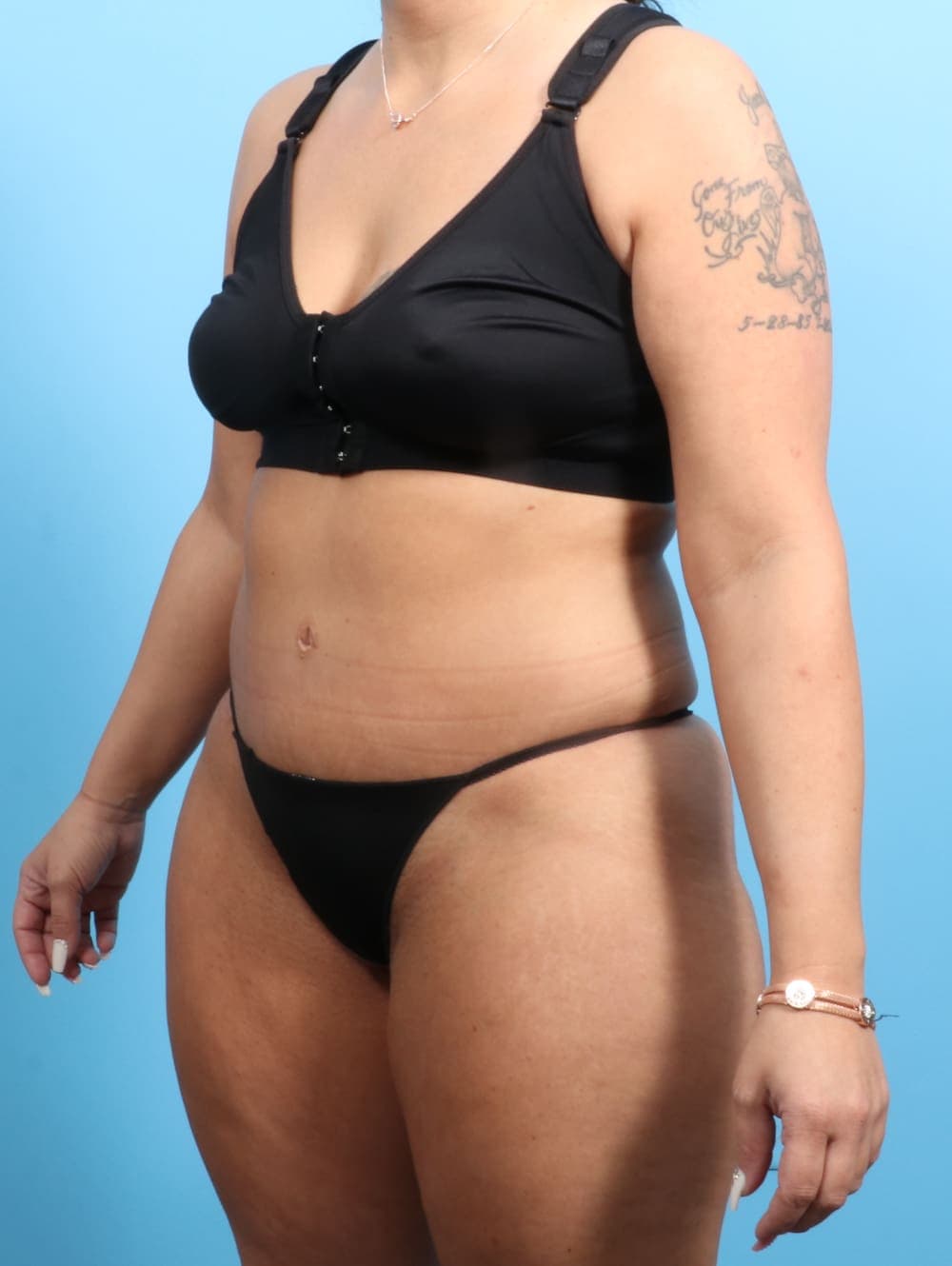 Liposuction case #2187 after, image 2