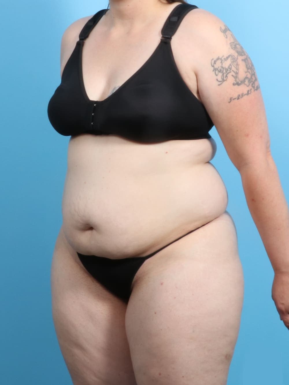 Liposuction case #2187 before, image 2