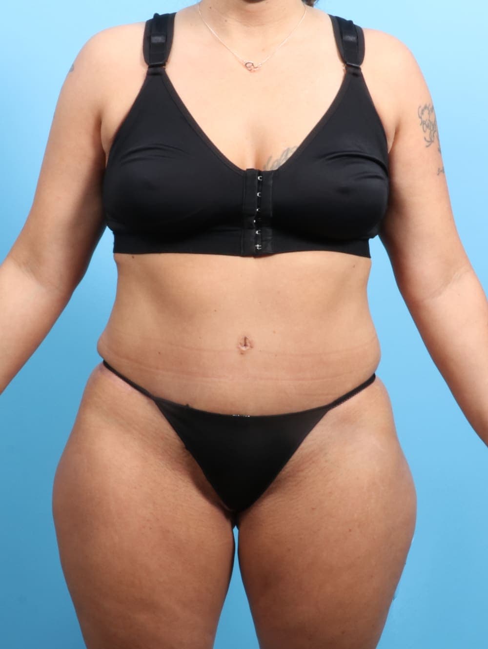 Liposuction case #2187 after, image 1