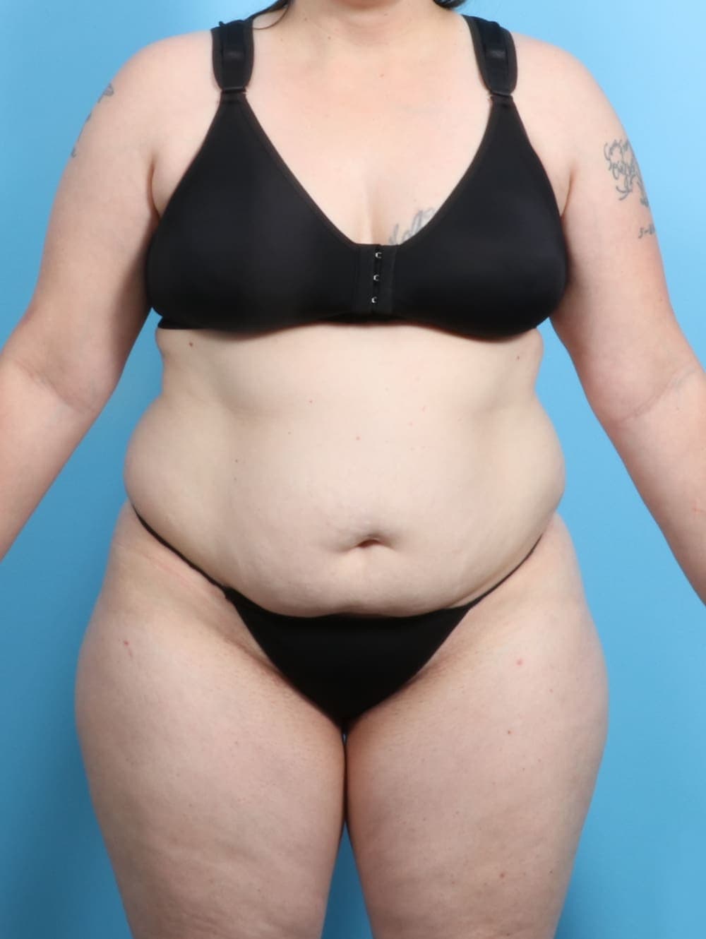 Liposuction case #2187 before, image 1