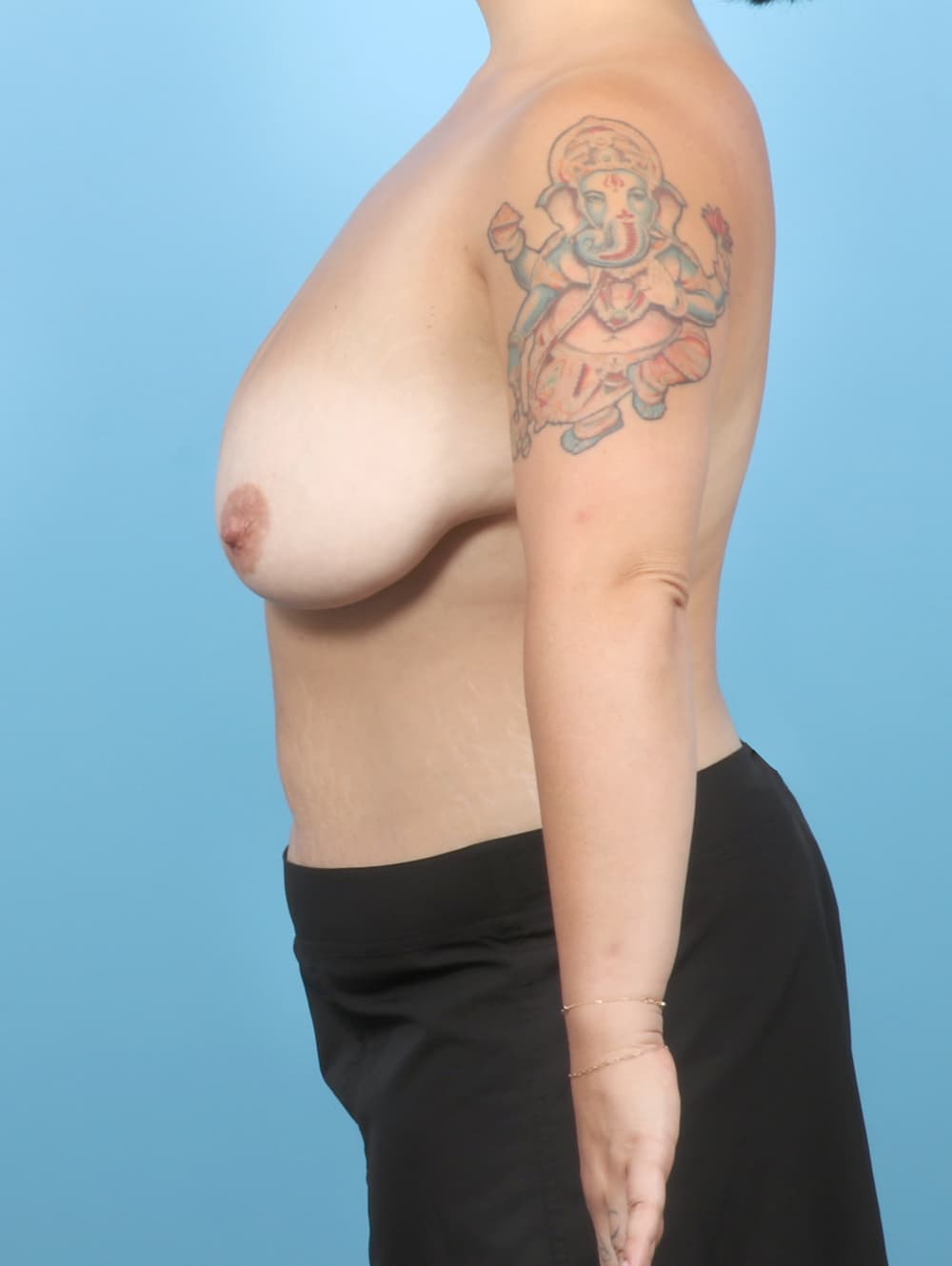 Breast Lift/Reduction case #7750 before, image 3