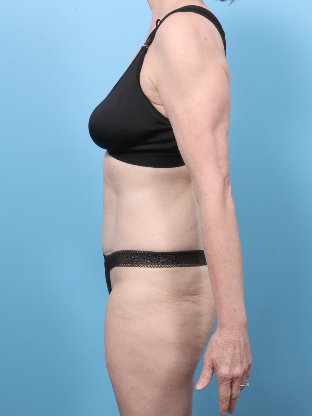 Tummy Tuck case #8352 after, image 3