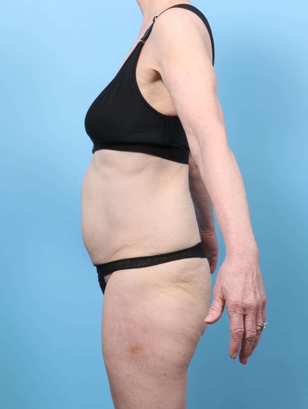 Tummy Tuck case #8352 before, image 3