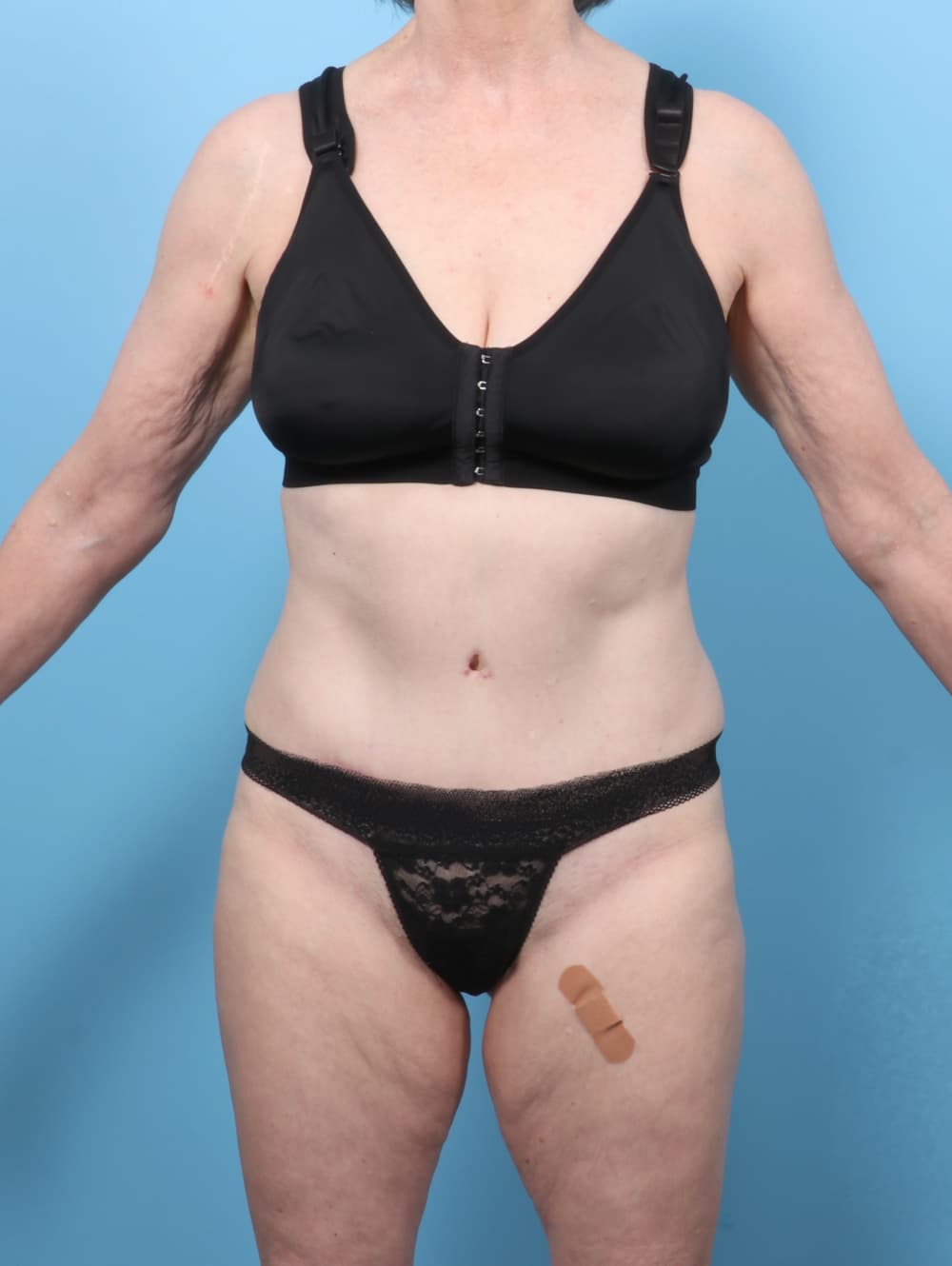 Tummy Tuck case #8352 after